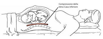 COMPRESSIONE FETO IN GRAVIDANZA