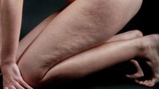Cellulite: Rimedi naturali e terapie per eliminarla