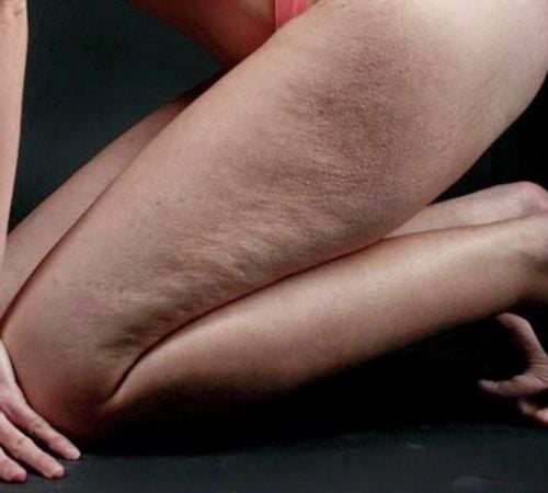 Cellulite: Rimedi e terapie per eliminarla