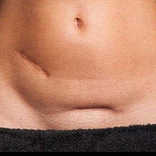 Cicatrice ipertrofica: rimedi e consigli