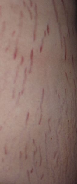 striae distensae smagliatura