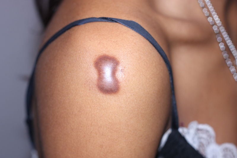 cicatrice cheloide