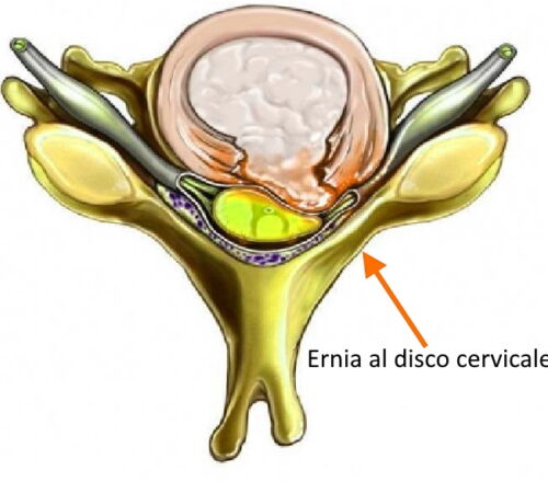 ernia cervicale