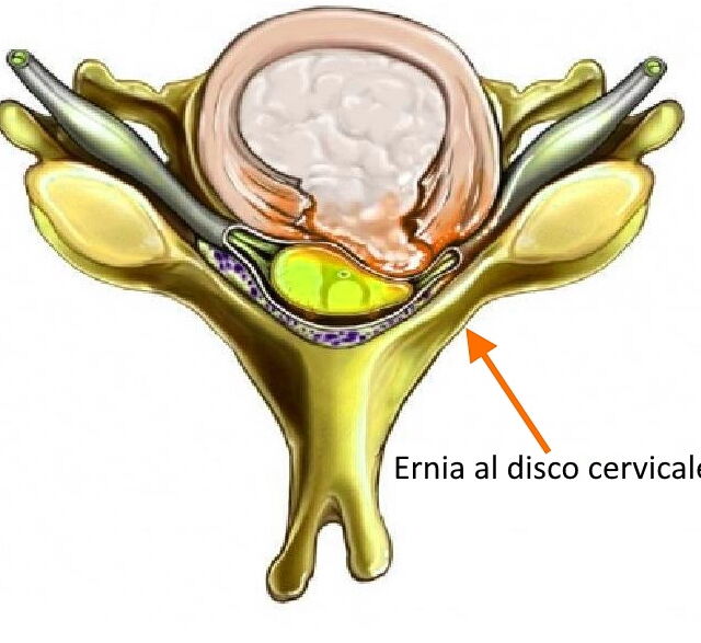 ernia cervicale