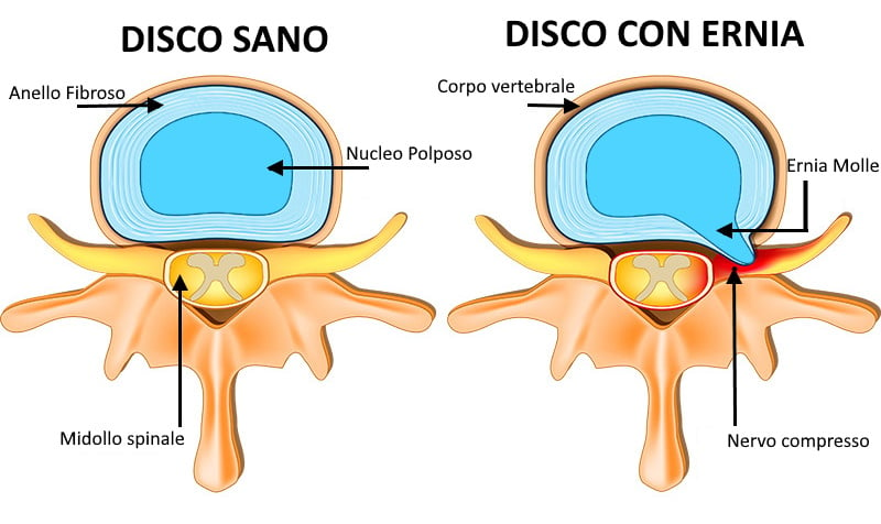 ernia cervicale sintomi