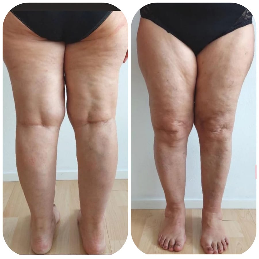 Lipedema  Cause, sintomi, diagnosi e trattamento