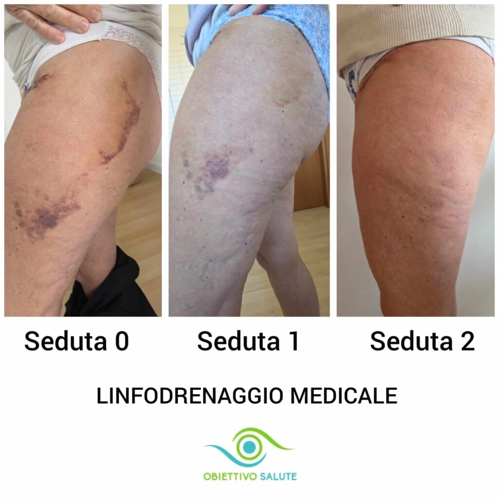 EMATOMA POST OPERATORIO