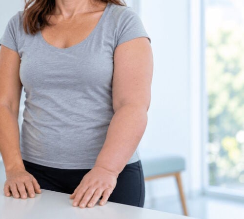 Donna con linfedema al braccio e gonfiore dell&rsquo;arto superiore