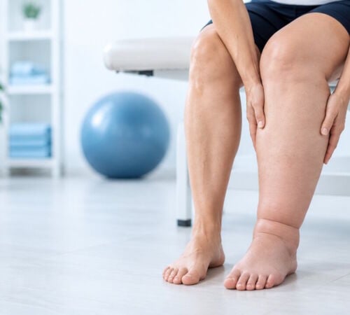 Linfedema a un arto inferiore