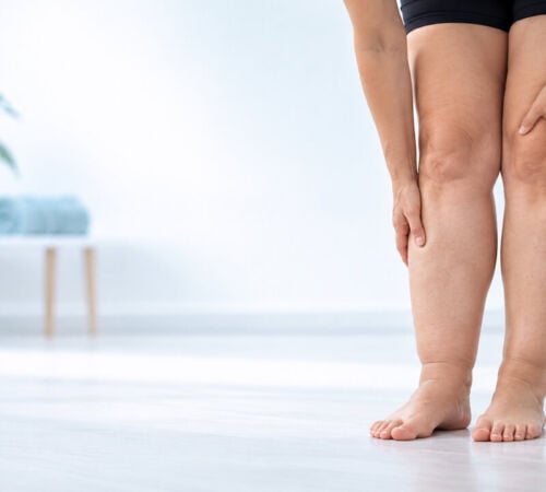 Ritenzione idrica o linfedema alle gambe